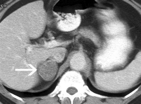 cushing's syndrome mri